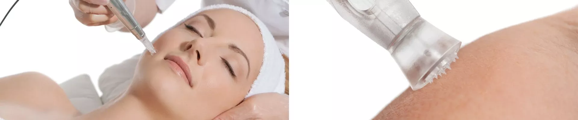 Microneedling Behandlung für eine strahlend schöne Haut ABSOLUT BEAUTY